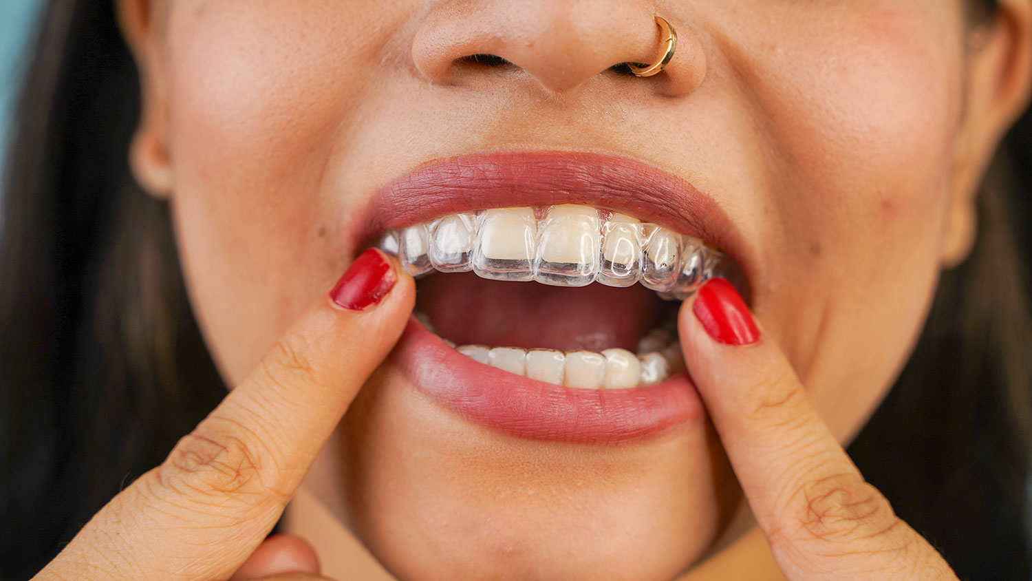 Invisalign Tips: Your Complete Guide To Clear Aligners